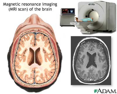 MRI of the brain