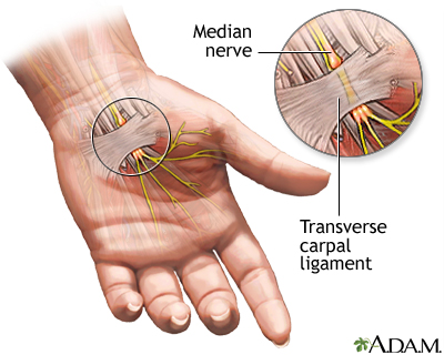 Compression of the median nerve