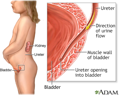 Vesicoureteral reflux