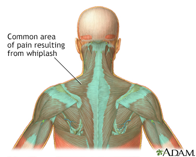 Location of whiplash pain