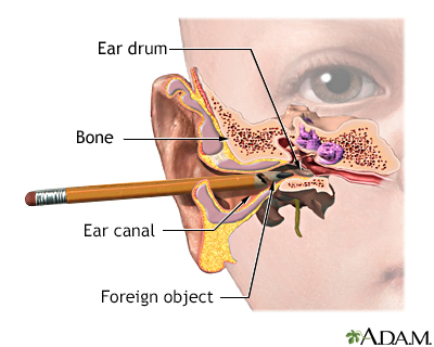 Foreign object in ear