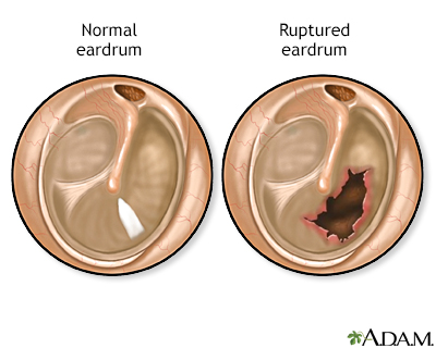 Ruptured eardrum