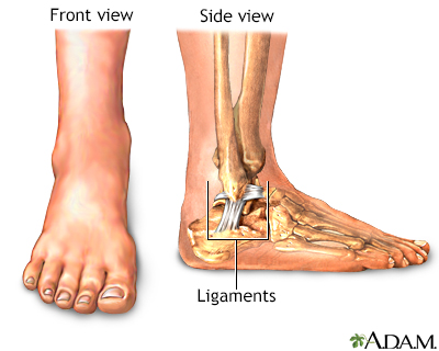 Ankle sprain - Series