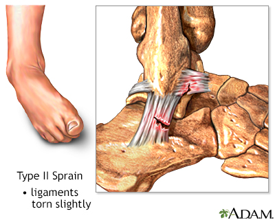 Type II ankle sprain