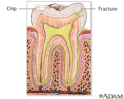 Fractured tooth