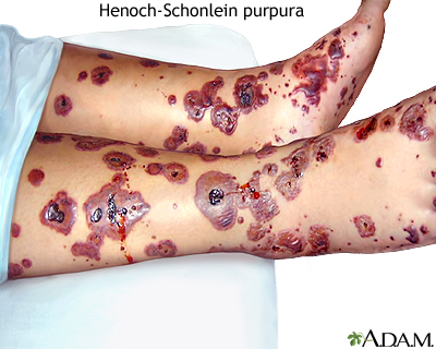 Henoch-Schonlein purpura