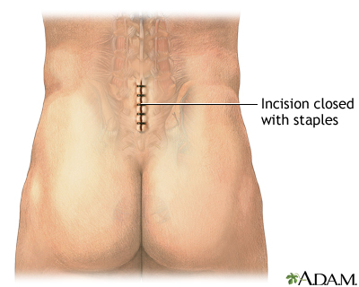 Microdiskectomy - Aftercare