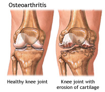 FS Knees osteoarthritis