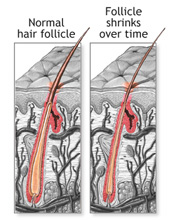 FS Comb over follicles