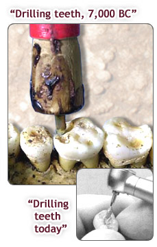 FS Dentist drilling comparison