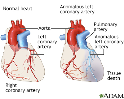 Anomalous left coronary artery