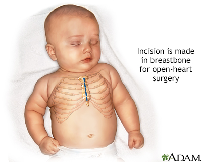 Infant open heart surgery