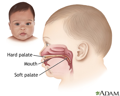 Cleft lip repair - series