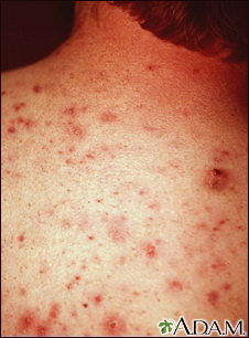 Acne - vulgaris on the back