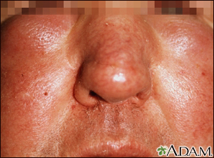Edema - central on the face