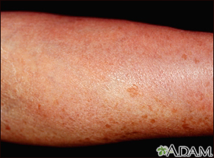 Mastocytosis - diffuse cutaneous