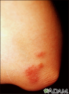 Sarcoidosis on the elbow