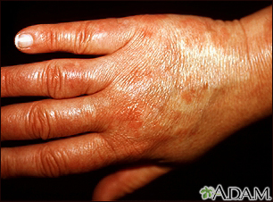 Vasculitis - urticarial on the hand