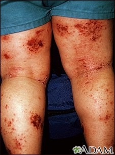 Dermatitis - atopic on the legs