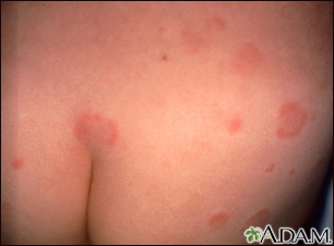 Hives (urticaria) on the back and buttocks