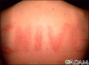 Dermatographism on the back