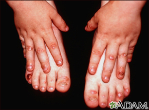 Epidermolysis bullosa, dystrophic