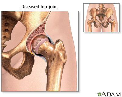 Diseased hip