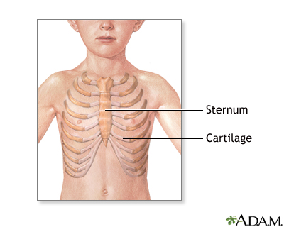 Pectus excavatum repair - series