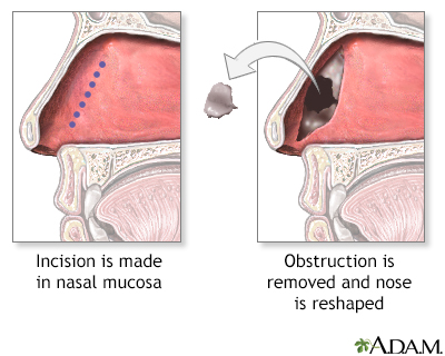 Procedure - Septoplasty