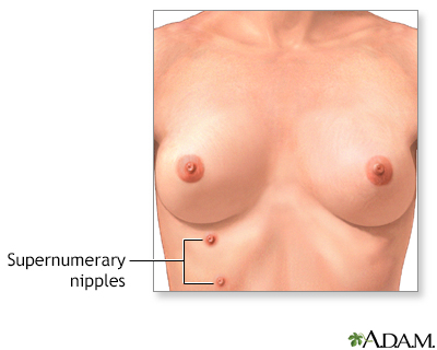 Supernumerary nipples