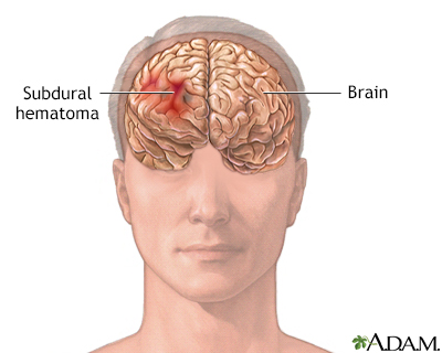 Subdural hematoma