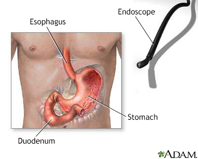 Gastric endoscopy