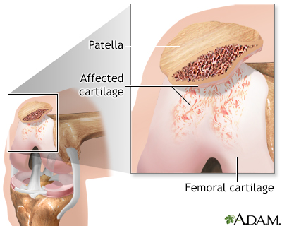 Chondromalacia of the patella