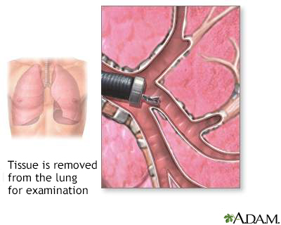 Bronchoscopic culture