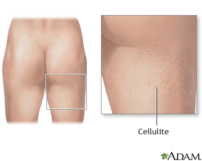 Cellulite