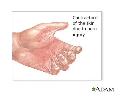 Contracture deformity