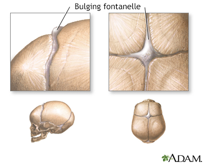 Bulging fontanelles