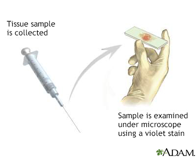 Gram stain of tissue biopsy