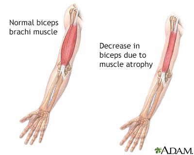 Muscular atrophy