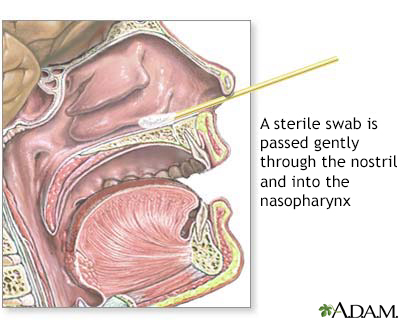 Nasopharyngeal culture