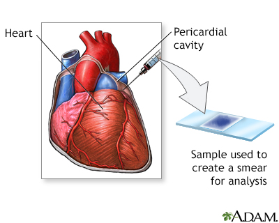 Pericardial fluid stain