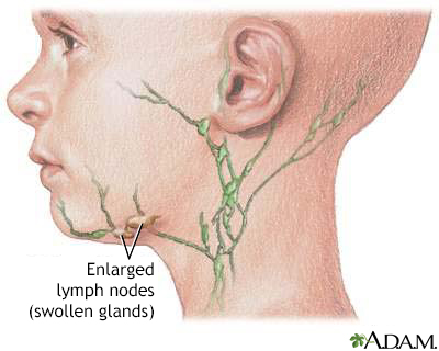 Swollen lymph node