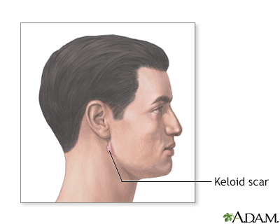 Keloid scar