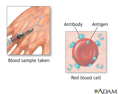 Herpes blood test