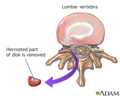 Herniated disk repair