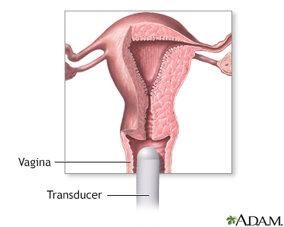 Transvaginal ultrasound