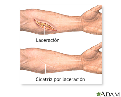 Extirpación quirúrgica de una cicatriz - serie