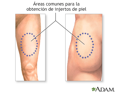 Injerto de piel - serie