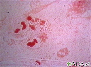 El organismo Haemophilus influenzae