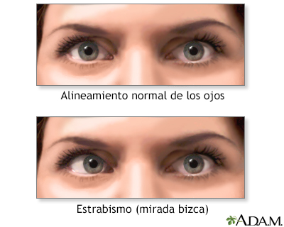 Ojos bizcos (estrabismo)